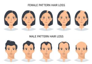 Proces łysienia kobiet i mężczyzn